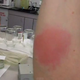 Image for article titled Man Gives Himself A Tattoo By Letting 1,000 Bed Bugs Feed On Him